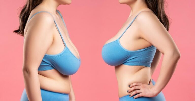 Breast Reduction in Turkey
